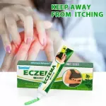 Eczema Cream | Dermatitis, Psoriasis & Anti-Itch Antibacterial Treatment