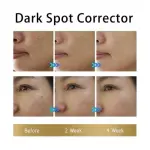 EELHOE Dark Spot Corrector – Skin Brightening Serum for Pigmentation, Acne Marks & Uneven Tone