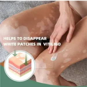 Vitiligo Relief Cream 20G, Treatment for Skin Vitiligo Ointment, Fade White Spot and Improve Skin Pigmentation Cream, Vitiligo Cream for Skin Healthy Care