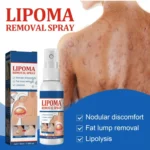 Lipoma Removal Cream 20g, Lipoma Removal Cream Ointment, Lipoma Elimination Cream - Image 2