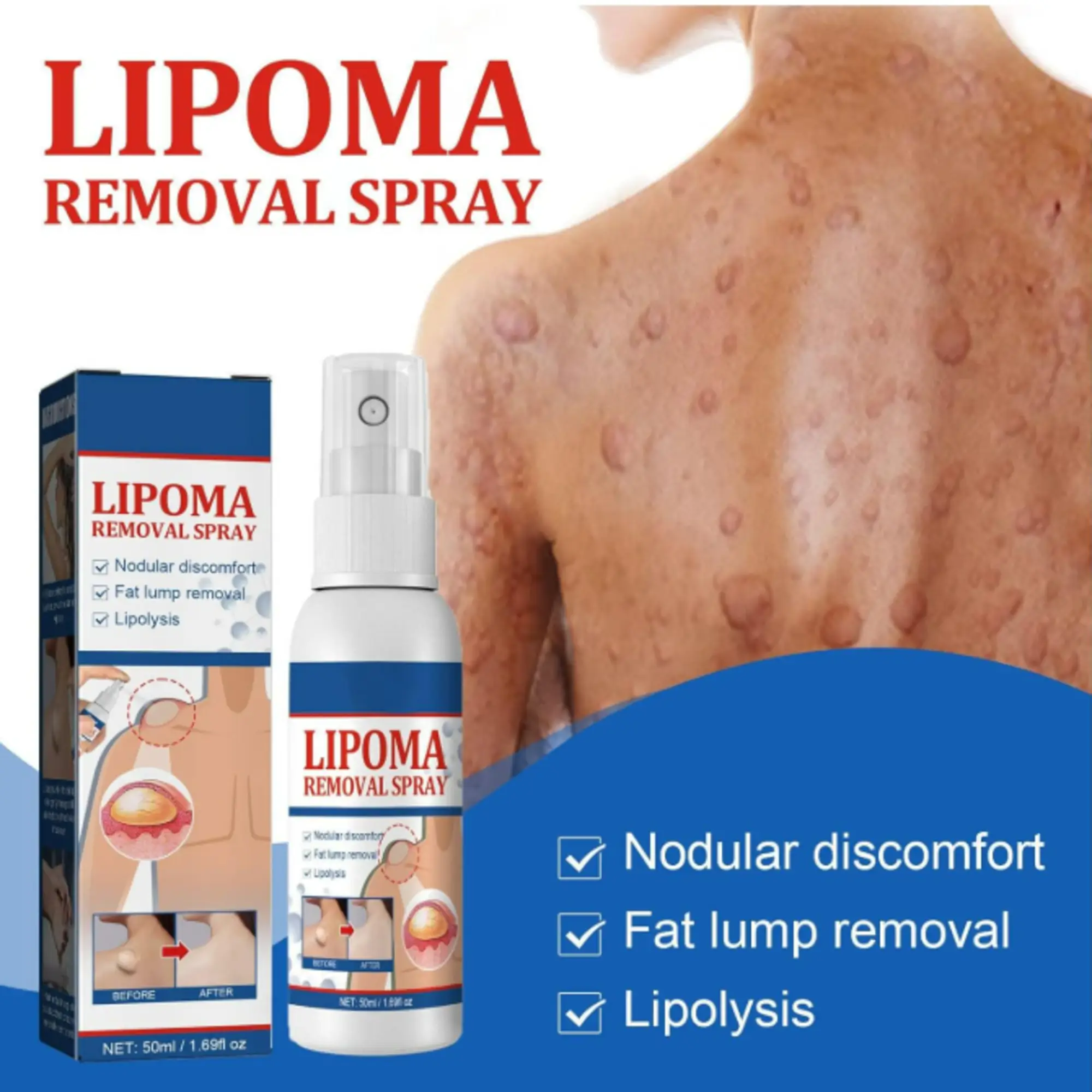 2-1-4.webp Lipoma Removal Cream 20g, Lipoma Removal Cream Ointment, Lipoma Elimination Cream - Image 2