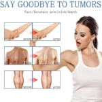 Lipoma Removal Cream 20g, Lipoma Removal Cream Ointment, Lipoma Elimination Cream - Image 5